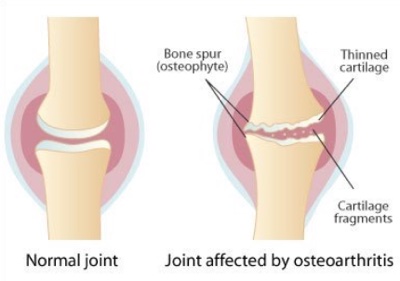 Treat Arthritis - NJ Morris County