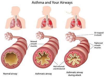 asthma treatment & diagnosis Morris County 
