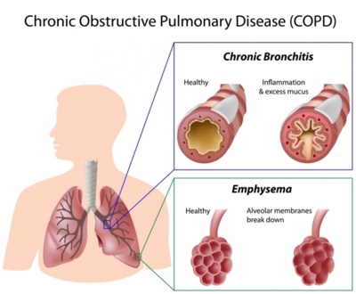 COPD treatment in NJ