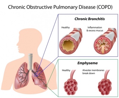 Link Between Urinary Incontinence and COPD