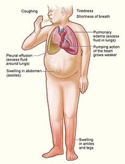 Congestive Heart Failure - Treatment in NJ