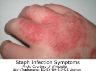 eczema