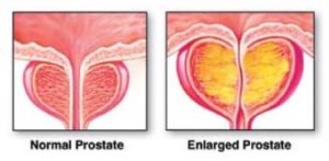 Enlarged Prostate - Advanced Cardiology and Primary Care LLC