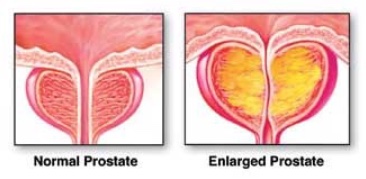 prostate