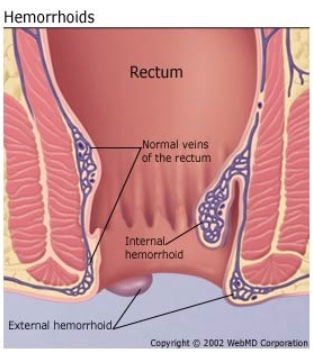 internal hemorrhoid swelling