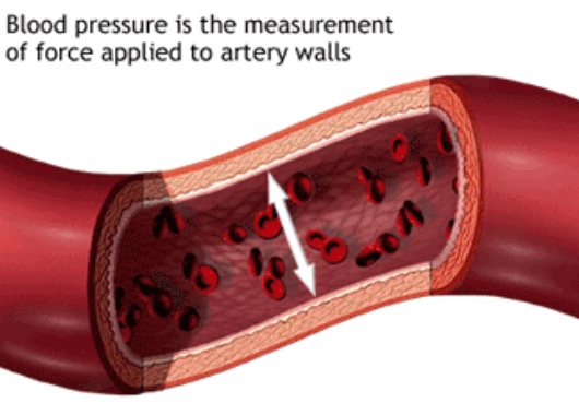 hypertension