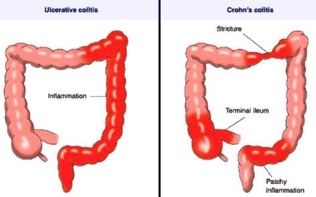 What is inflammatory bowel disease (IBD)?