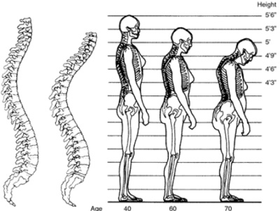 Osteoporosis