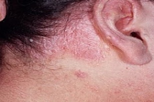 psoriasis