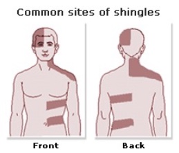 dermatomes face shingles