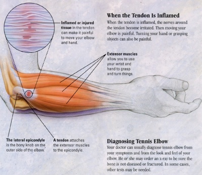 Tennis Elbow