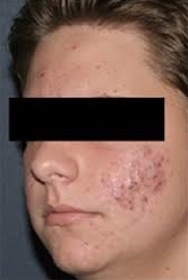 acne treatment by NJ doctor
